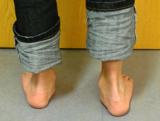Knicksenkfuß