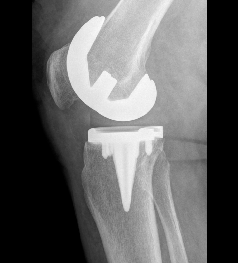 Röntgenbild eines operierten Kniegelenks